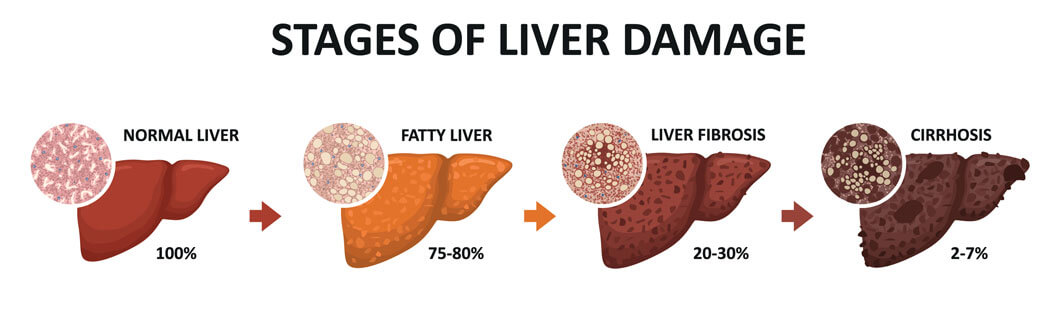 4 stages of liver damage from a normal liver to cirrhosis
